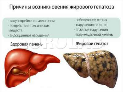 Гепатоз печени: причины, симптомы и лечение 