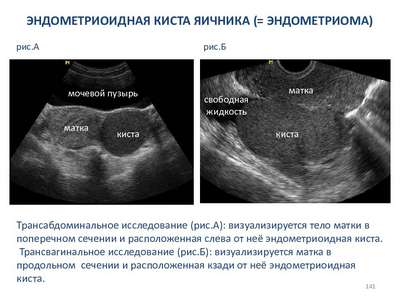 Эндометриоидная киста яичника (левого, правого): беременность, лечение 